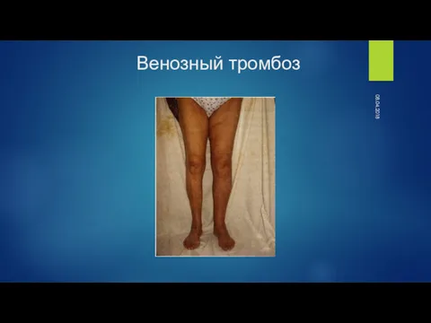 08.04.2018 Венозный тромбоз