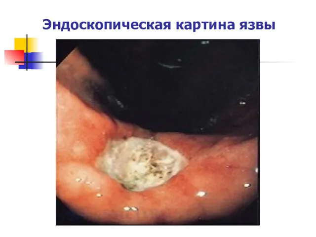 Эндоскопическая картина язвы