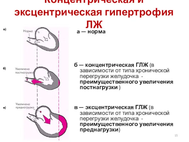 Концентрическая и эксцентрическая гипертрофия ЛЖ а — норма б —