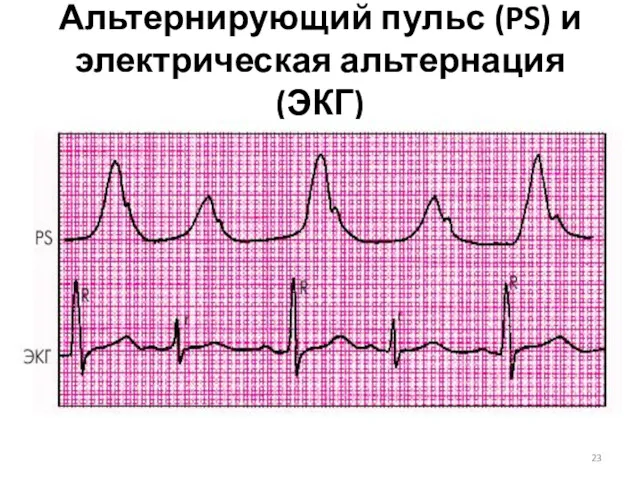 Альтернирующий пульс (PS) и электрическая альтернация (ЭКГ)