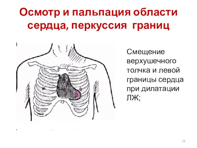 Осмотр и пальпация области сердца, перкуссия границ Смещение верхушечного толчка