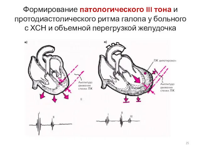 Формирование патологического III тона и протодиастолического ритма галопа у больного с ХСН и объемной перегрузкой желудочка