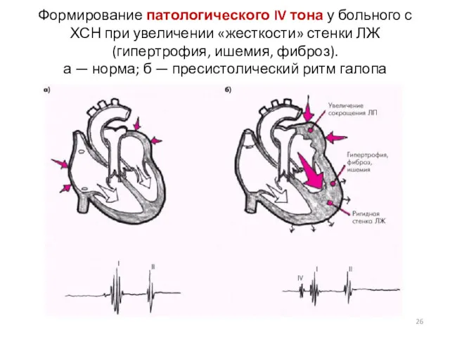 Формирование патологического IV тона у больного с ХСН при увеличении