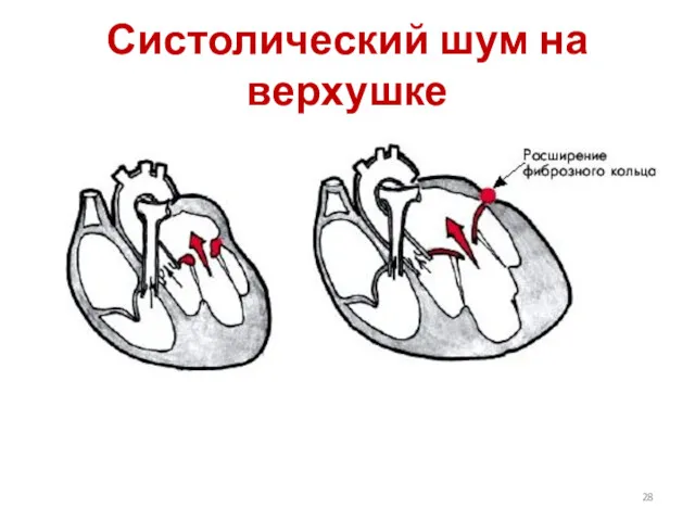 Систолический шум на верхушке