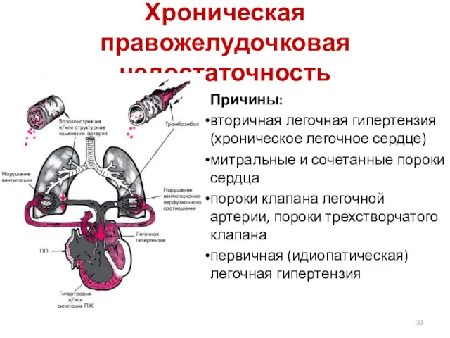 Хроническая правожелудочковая недостаточность Причины: вторичная легочная гипертензия (хроническое легочное сердце)