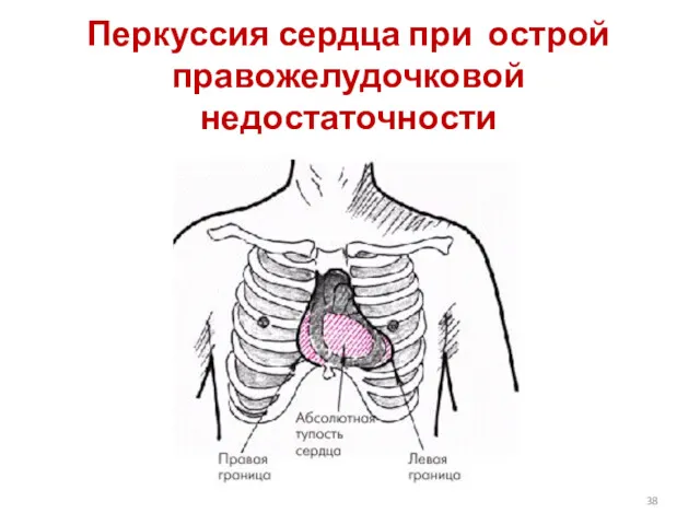 Перкуссия сердца при острой правожелудочковой недостаточности