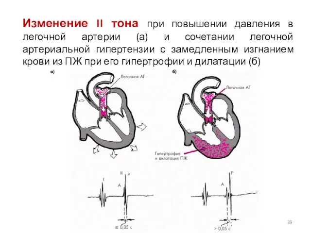 Изменение II тона при повышении давления в легочной артерии (а)