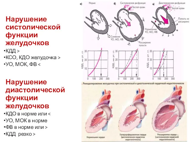 Нарушение систолической функции желудочков КДД > КСО, КДО желудочка >