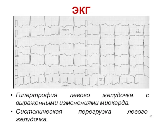 ЭКГ Гипертрофия левого желудочка с выраженными изменениями миокарда. Систолическая перегрузка левого желудочка.