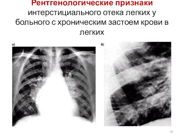 Рентгенологические признаки интерстициального отека легких у больного с хроническим застоем крови в легких