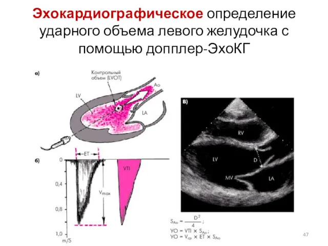 Эхокардиографическое определение ударного объема левого желудочка с помощью допплер-ЭхоКГ