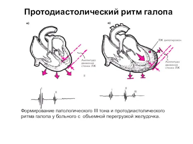 Протодиастолический ритм галопа Формирование патологического III тона и протодиастолического ритма