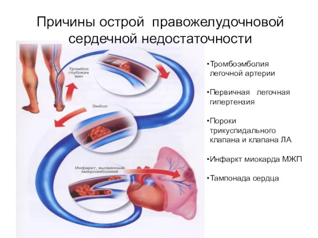 Тромбоэмболия легочной артерии Первичная легочная гипертензия Пороки трикуспидального клапана и
