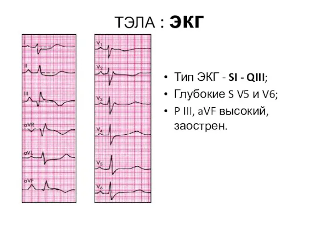 ТЭЛА : экг Тип ЭКГ - SI - QIII; Глубокие