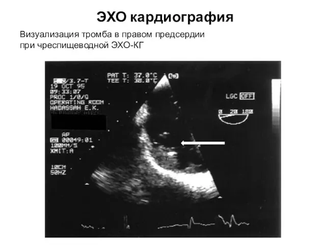 ЭХО кардиография Визуализация тромба в правом предсердии при чреспищеводной ЭХО-КГ