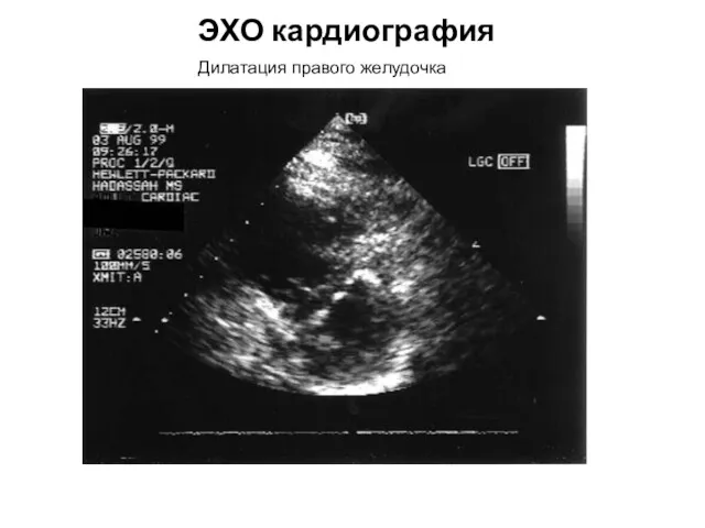 ЭХО кардиография Дилатация правого желудочка