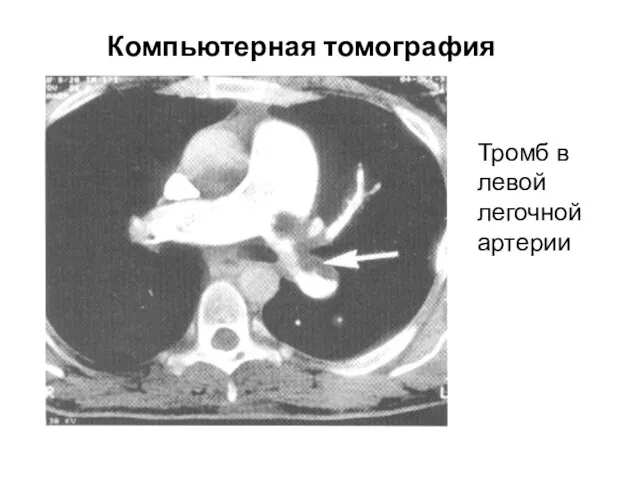 Компьютерная томография Тромб в левой легочной артерии