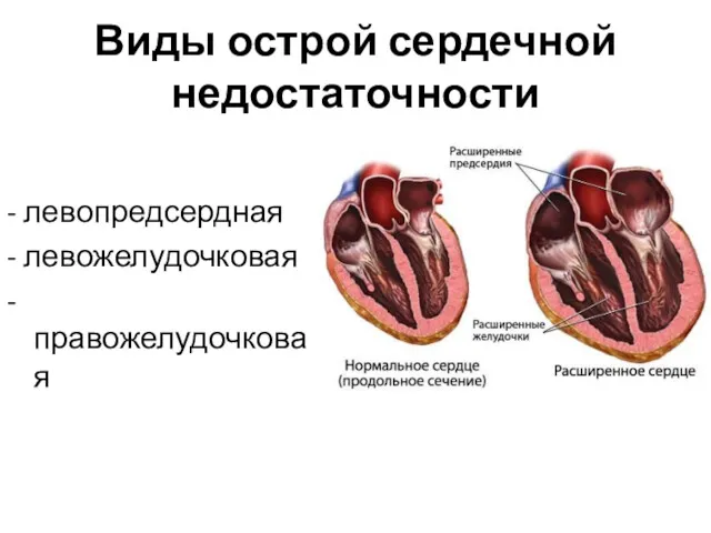 Виды острой сердечной недостаточности - левопредсердная - левожелудочковая - правожелудочковая