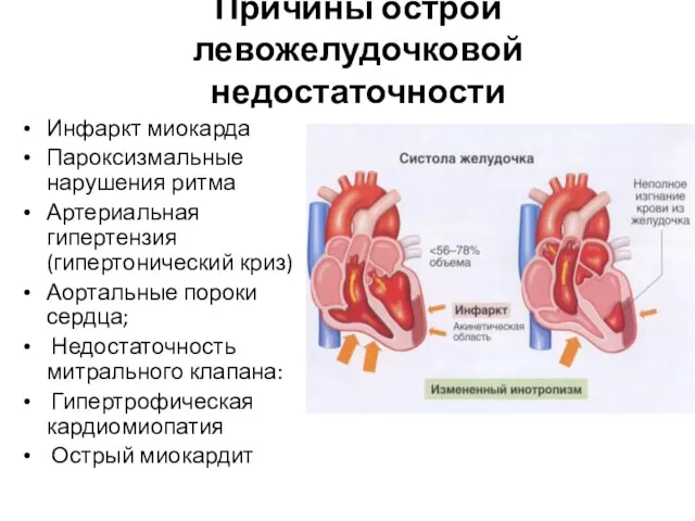 Причины острой левожелудочковой недостаточности Инфаркт миокарда Пароксизмальные нарушения ритма Артериальная