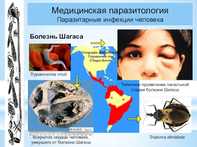 Медицинская паразитология Паразитарные инфекции человека Болезнь Шагаса Triatoma dimidiata Вскрытое
