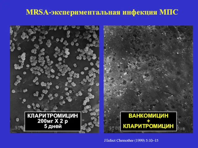 MRSA-экспериментальная инфекция МПС КЛАРИТРОМИЦИН 200мг Х 2 р 5 дней