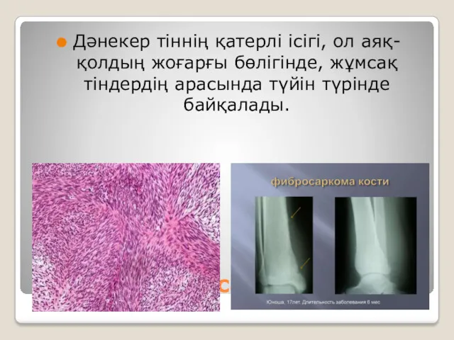 Фибросаркома Дәнекер тіннің қатерлі ісігі, ол аяқ-қолдың жоғарғы бөлігінде, жұмсақ тіндердің арасында түйін түрінде байқалады.