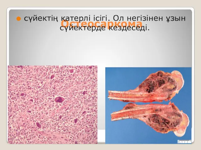 Остеосаркома сүйектің қатерлі ісігі. Ол негізінен ұзын сүйектерде кездеседі.