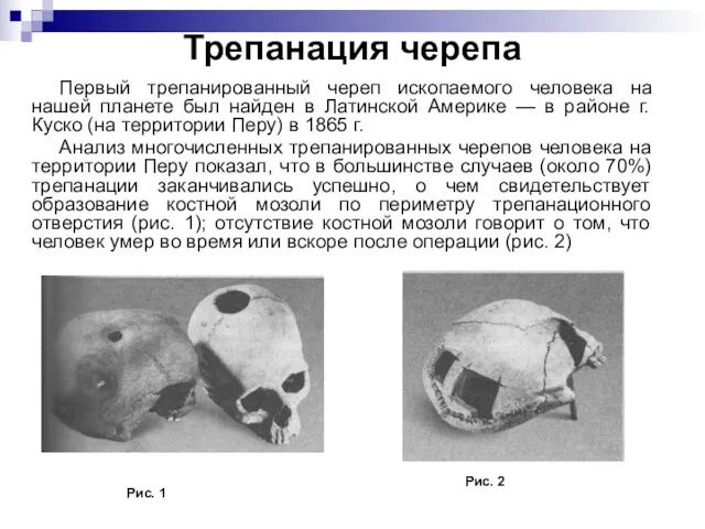 Трепанация черепа Первый трепанированный череп ископаемого человека на нашей планете был найден в