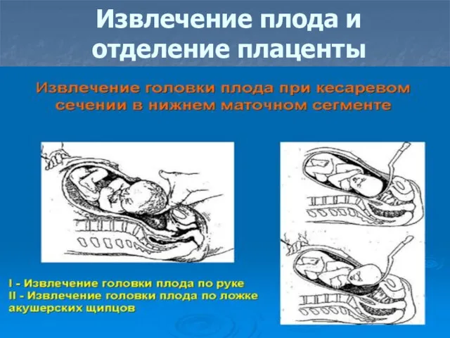 Извлечение плода и отделение плаценты