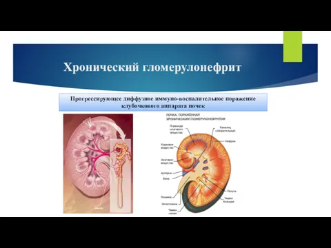 Хронический гломерулонефрит Прогрессирующее диффузное иммуно-воспалительное поражение клубочкового аппарата почек