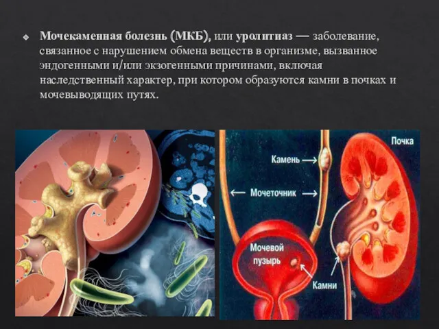 Мочекаменная болезнь (МКБ), или уролитиаз — заболевание, связанное с нарушением