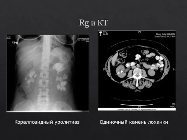 Rg и КТ Коралловидный уролитиаз Одиночный камень лоханки