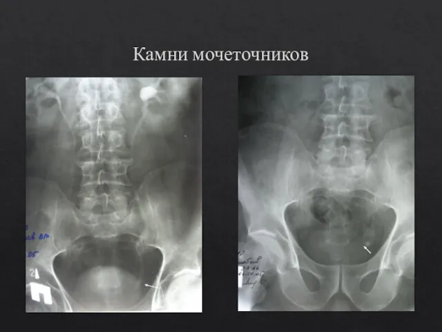 Камни мочеточников