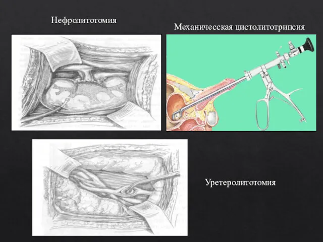 Механичесская цистолитотрипсия Нефролитотомия Уретеролитотомия