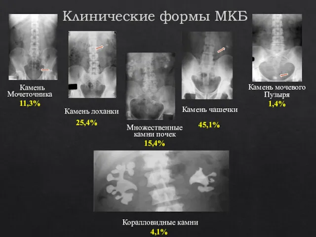 Клинические формы МКБ Камень мочевого Пузыря 1,4% Коралловидные камни 4,1%