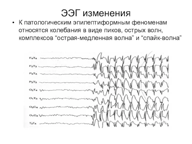 ЭЭГ изменения К патологическим эпилептиформным феноменам относятся колебания в виде пиков, острых волн,