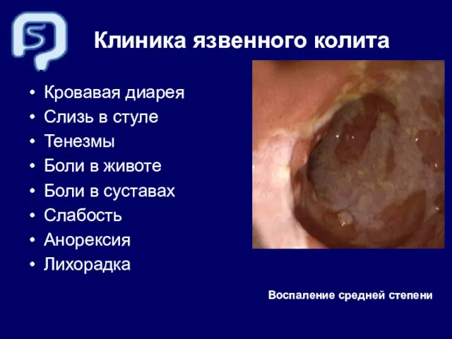 Клиника язвенного колита Кровавая диарея Слизь в стуле Тенезмы Боли