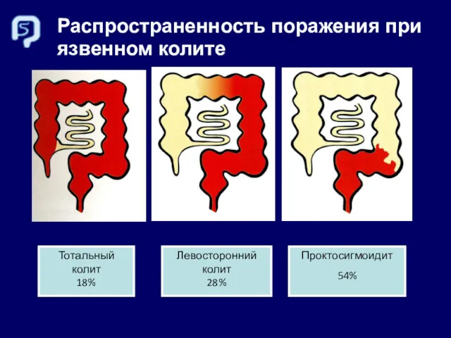 Распространенность поражения при язвенном колите Тотальный колит 18% Левосторонний колит 28% Проктосигмоидит 54%