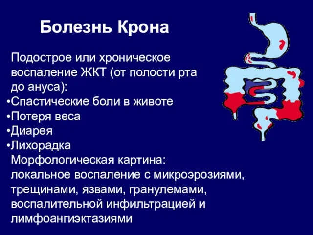 Болезнь Крона Подострое или хроническое воспаление ЖКТ (от полости рта