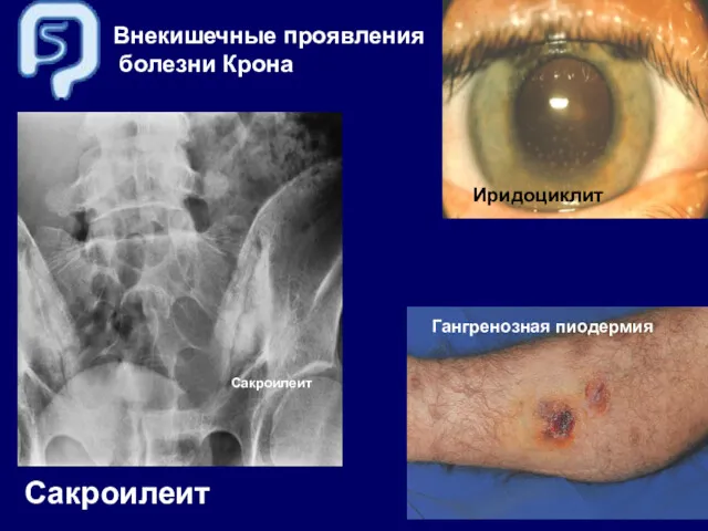 Сакроилеит Сакроилеит Внекишечные проявления болезни Крона Иридоциклит Гангренозная пиодермия
