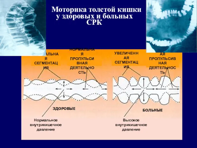 Моторика толстой кишки у здоровых и больных СРК НОРМАЛЬНАЯ СЕГМЕНТАЦИЯ