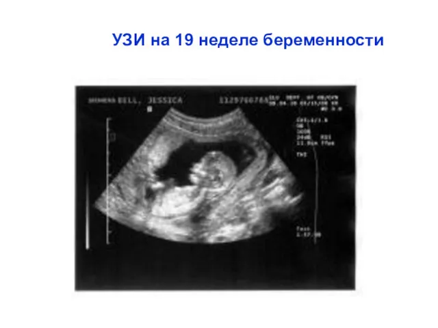 УЗИ на 19 неделе беременности