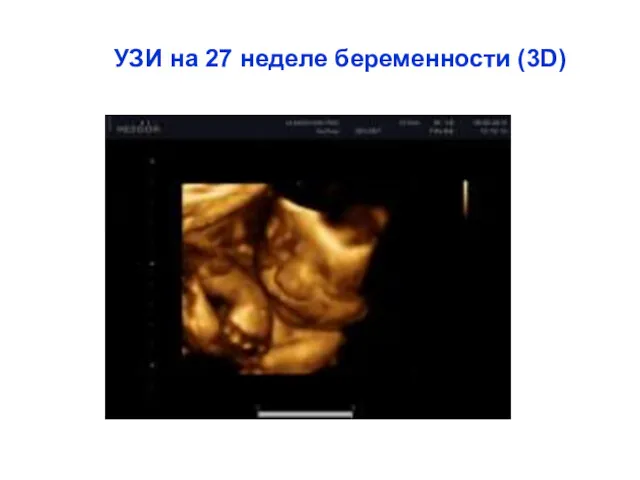 УЗИ на 27 неделе беременности (3D)