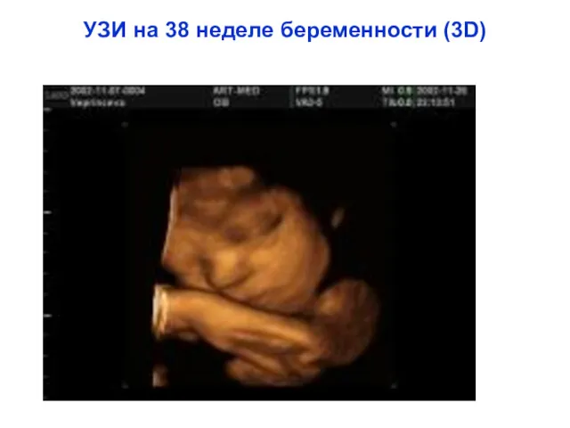 УЗИ на 38 неделе беременности (3D)