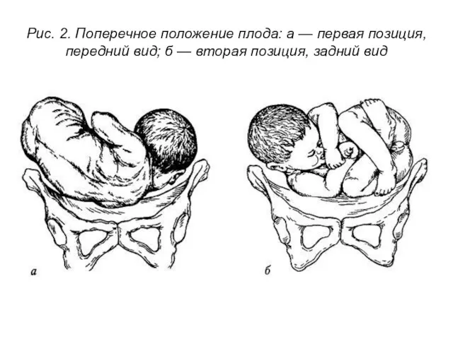 Рис. 2. Поперечное положение плода: а — первая позиция, передний