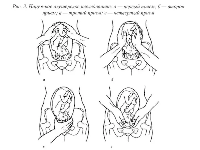 Рис. 3. Наружное акушерское исследование: а — первый прием; б