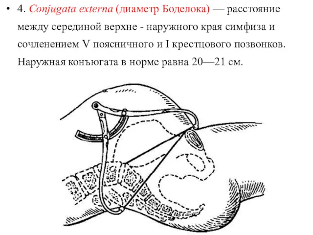 4. Conjugata externa (диаметр Боделока) — расстояние между серединой верхне