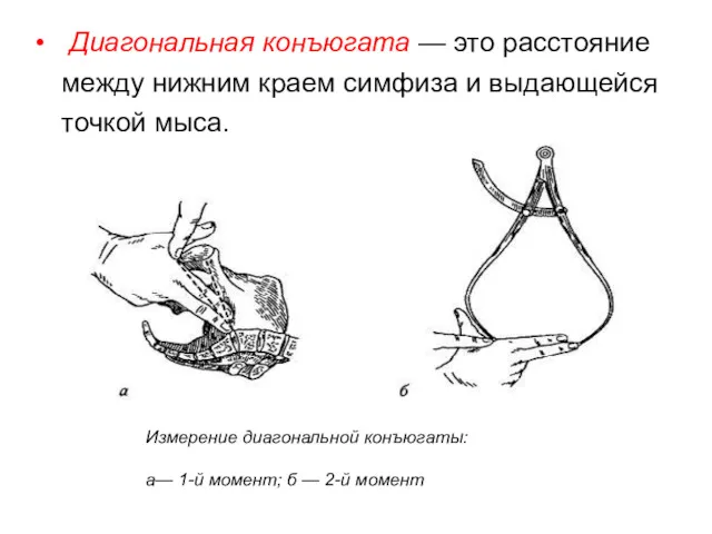 Диагональная конъюгата — это расстояние между нижним краем симфиза и