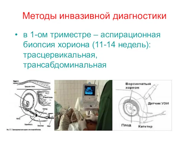 Методы инвазивной диагностики в 1-ом триместре – аспирационная биопсия хориона (11-14 недель): трасцервикальная, трансабдоминальная