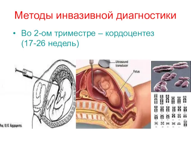 Методы инвазивной диагностики Во 2-ом триместре – кордоцентез (17-26 недель)